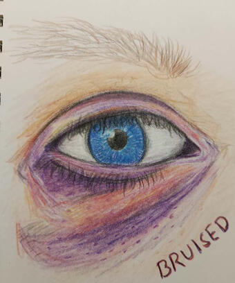 Bruised
